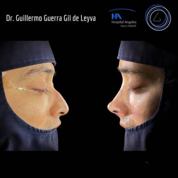 Slider image (2) Dr. Guillermo Guerra Gil de Leyva - Rhinoplasty Specialist